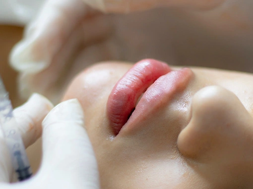 Sydney Lip Filler Clinic: A Procedure Process You Can Trust